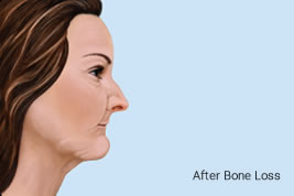 After Bone Loss