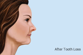 After Tooth Loss
