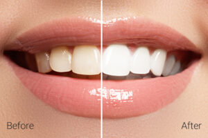 teeth whitening treatment
